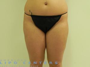 americanlipocenters_151.jpg